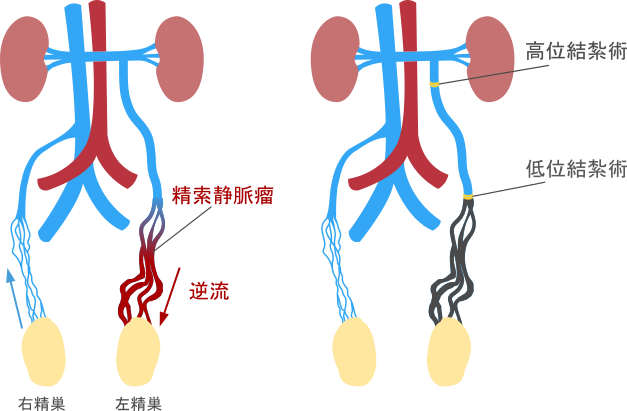 精索静脈瘤が発症する原因は何ですか?